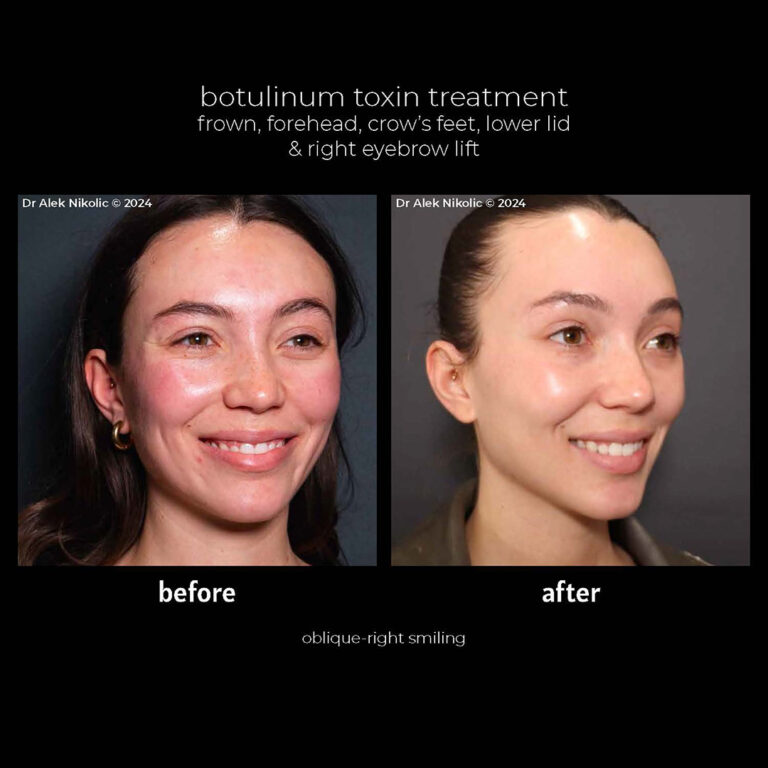 Botox Treatment Cape Town - Dr Alek Nikolic