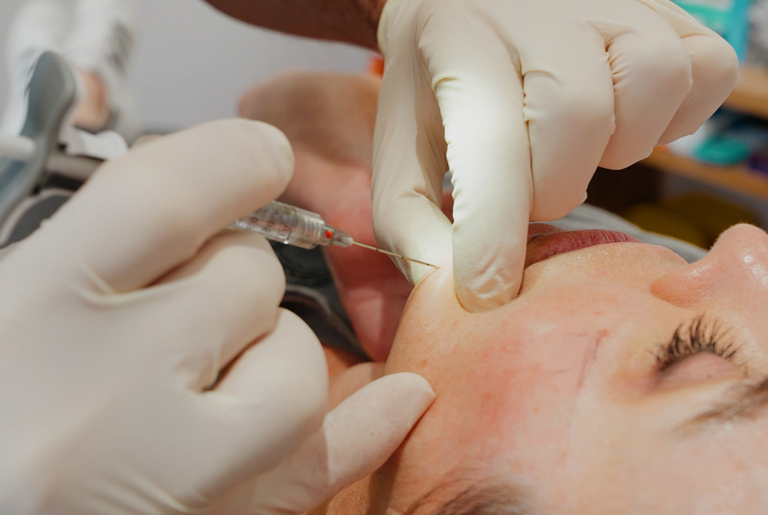 dermal-fillers-how-dermal-fillers-restore-facial-structure