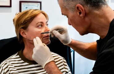 dermal-fillers-tear-trough-filler-under-eye-hollows