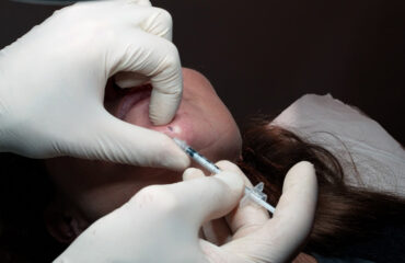 botulinum-toxin-beyond-frown-lines-lift-balance-lower-face botulinum-toxin-beyond-frown-lines-lift-balance-lower-face