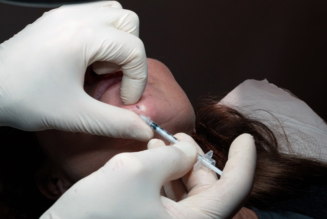 botulinum-toxin-beyond-frown-lines-lift-balance-lower-face