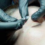 botulinum-toxin-brow-lift-gummy-smile