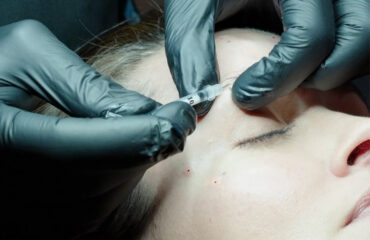botulinum-toxin-brow-lift-gummy-smile
