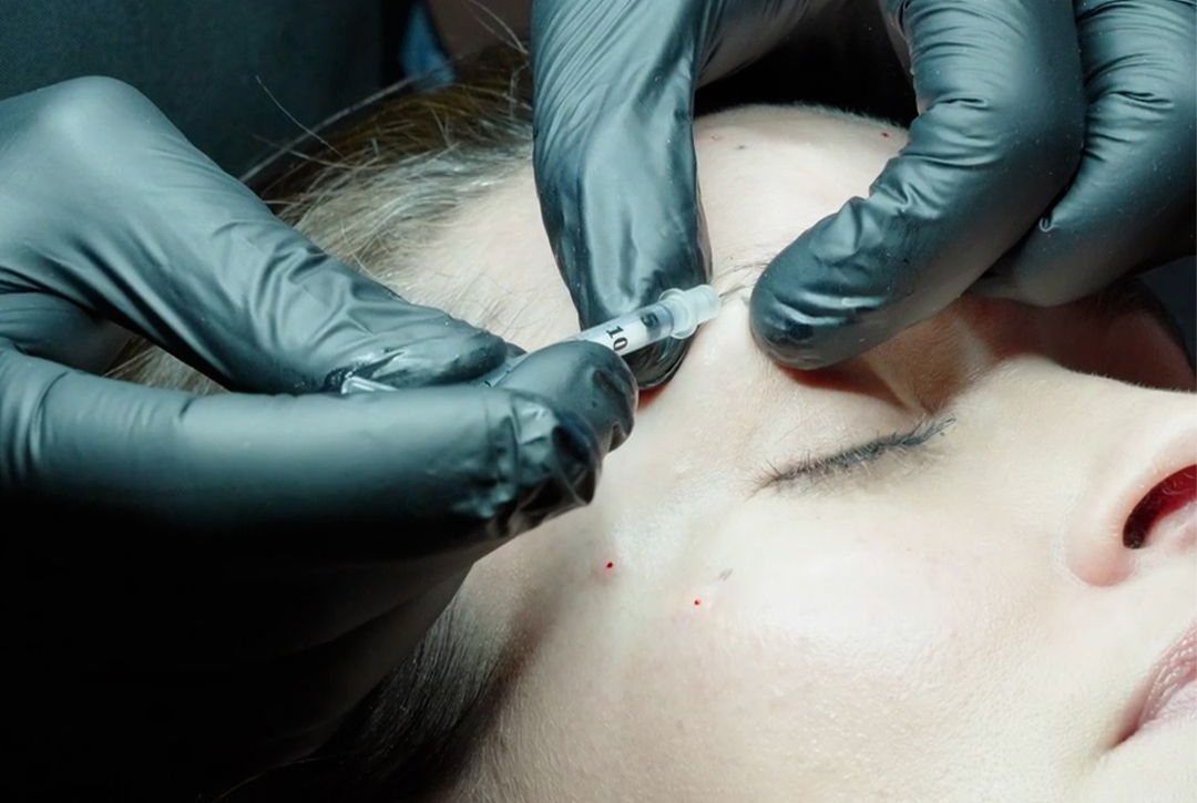 botulinum-toxin-brow-lift-gummy-smile