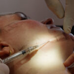 biostimulators-explained-how-collagen-stimulating-treatments-work