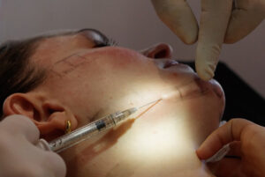 biostimulators-explained-how-collagen-stimulating-treatments-work