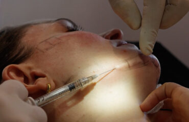 biostimulators-explained-how-collagen-stimulating-treatments-work biostimulators-explained-how-collagen-stimulating-treatments-work